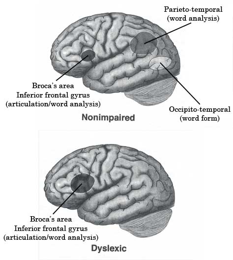 dyslexic brain